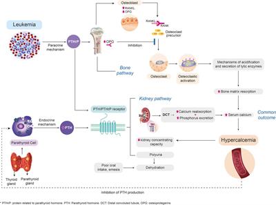 Malignant hypercalcemia as the debut of acute lymphoblastic leukemia in a pediatric patient—a diagnostic and therapeutic approach: Case report